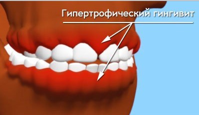 Клиническая картина фиброзной формы гипертрофического гингивита