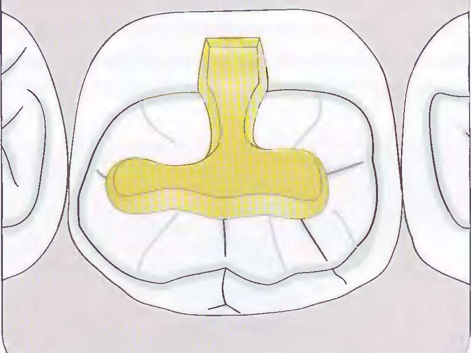 Полость под. Препарирование полости под вкладку. Принципы препарирования полостей под вкладки. Препарирование полости под вкладку Инлей. Препарирование полостей под вкладки Inlay.